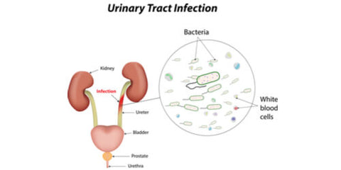 What Is a Urinary Tract Infection?