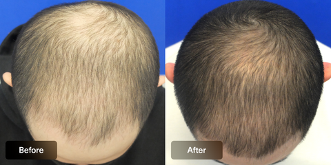 XYON before and after results of topical finasteride regrowing hairline.