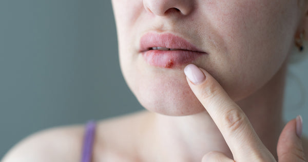 Woman with concerned expression due to cold sore on bottom lip