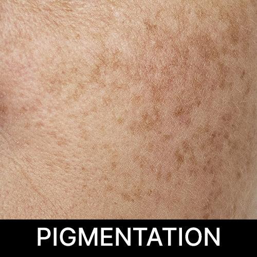 PIGMENTAION