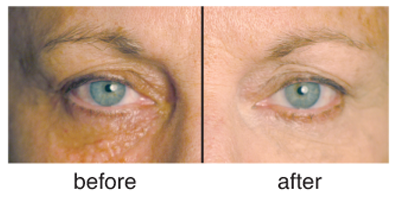 Before & After of Eyes using Firming Eye Cream
