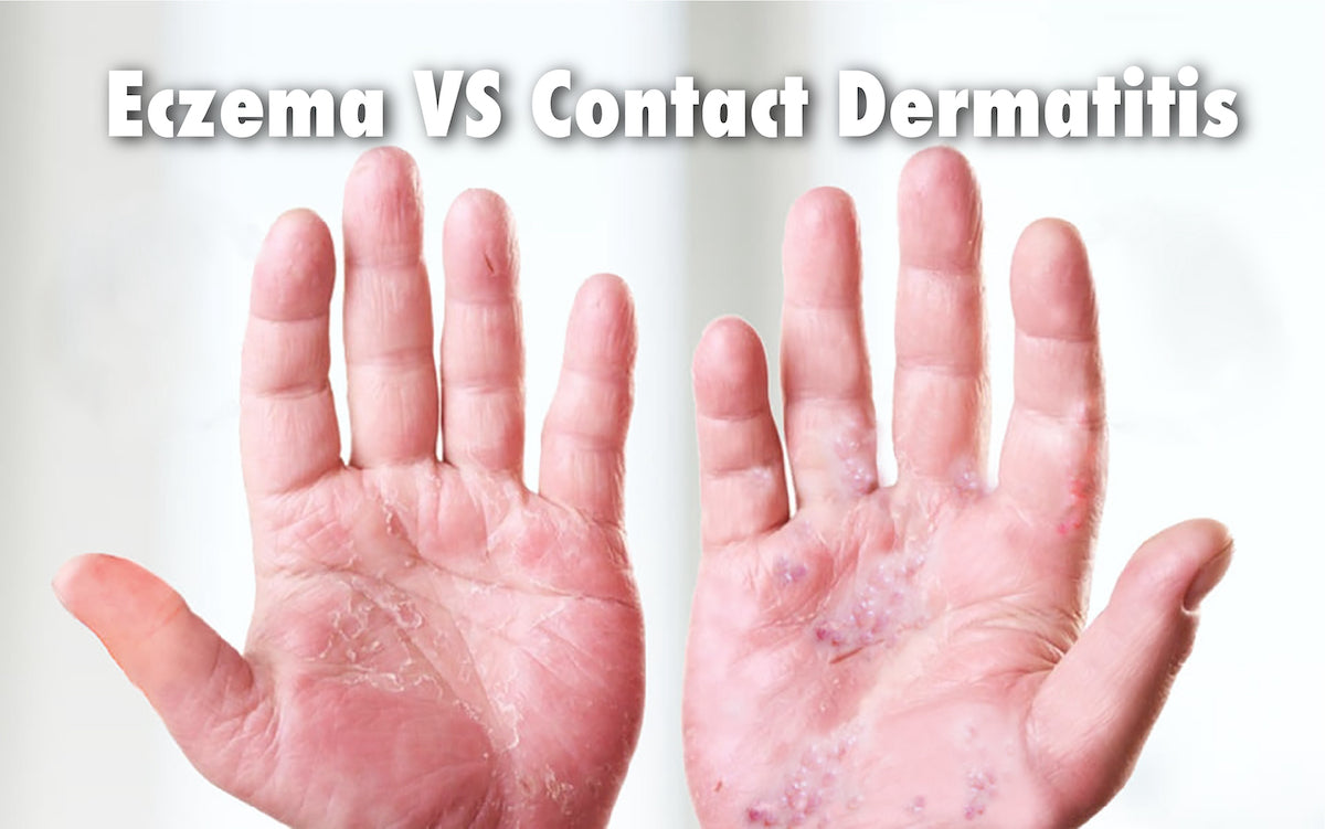 Eczema VS Contact Dermatitis