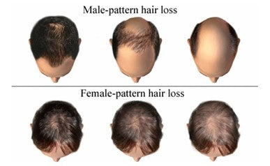 Androgene Alopezie Haarausfall