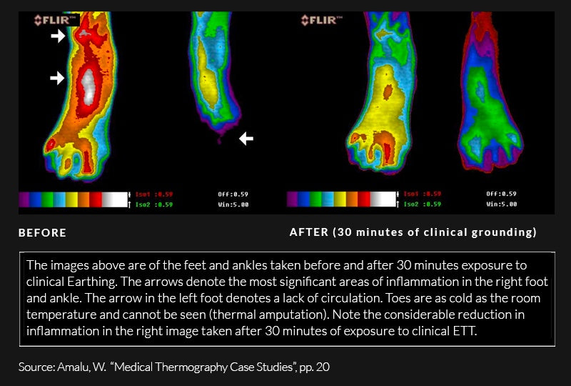 Thermal imaging of feet before and after 30-minute use of clinical earthing grounding system. Before image shows inflammation in right foot and left foot matching room temperature. After image shows significant improvement in circulation and inflammation.