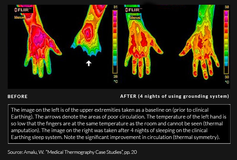 Thermal imaging of upper extremities before and after use of clinical earthing grounding system. Before image shows left hand with fingers at room temperature. After image shows significant improvement in circulation.