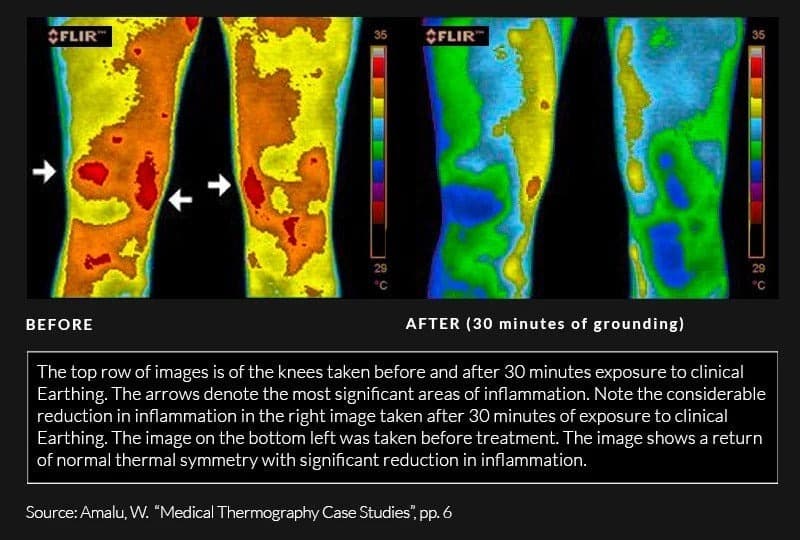 Thermographic study results of knees after being grounded earthing harmony