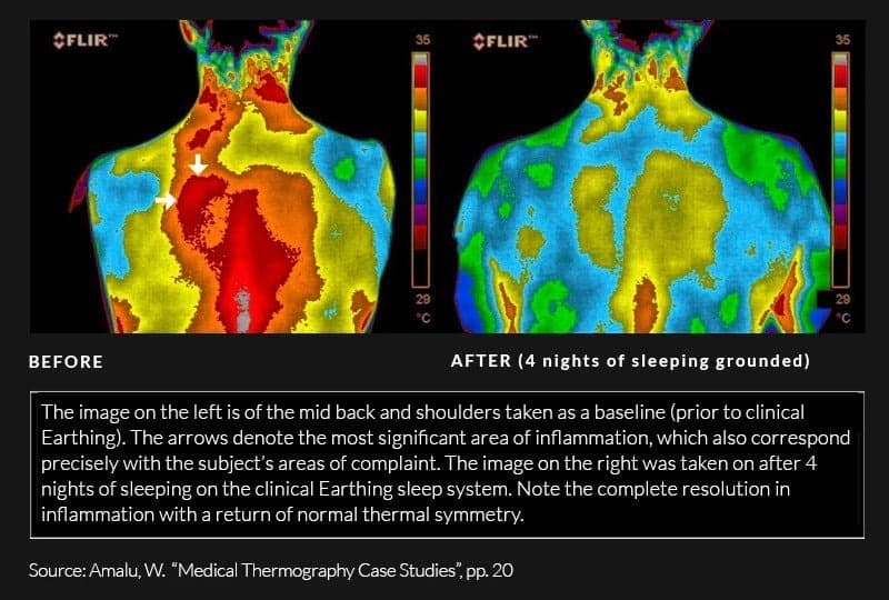 thermal imaging results of benefits after 4 nights of sleeping on grounded sleep system earthing harmony