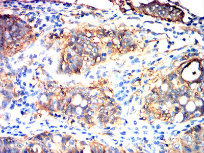 Figure 7:Immunohistochemical analysis of paraffin-embedded rectal cancer tissues using TSPAN8 mouse mAb with DAB staining.