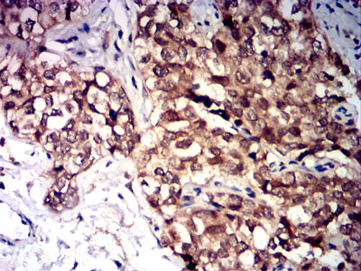 Figure 7:Immunohistochemical analysis of paraffin-embedded bladder cancer tissues using CD47 mouse mAb with DAB staining.