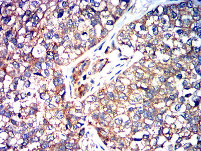 Figure 5:Immunohistochemical analysis of paraffin-embedded bladder cancer tissues using Siglec15 mouse mAb with DAB staining.