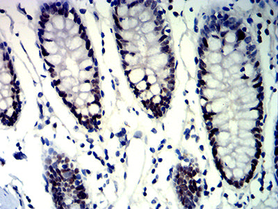 Figure 6:Immunohistochemical analysis of paraffin-embedded colon tissues using MSH6 mouse mAb with DAB staining.