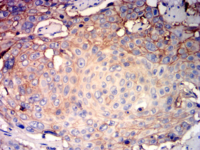 Figure 7:Immunohistochemical analysis of paraffin-embedded esophageal cancer tissues using ATP1A1 mouse mAb with DAB staining.