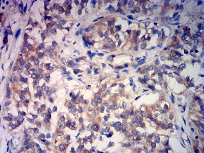 Figure 4:Immunohistochemical analysis of paraffin-embedded bladder cancer tissues using RABEP2 mouse mAb with DAB staining.