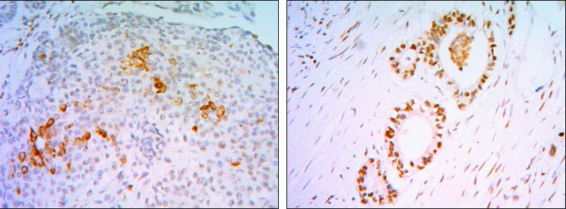 Figure 3: Immunohistochemical analysis of paraffin-embedded submaxillary gland tumor (left), colon cancer tissues (right) using STAT1 Rabbit pAb with DAB staining.