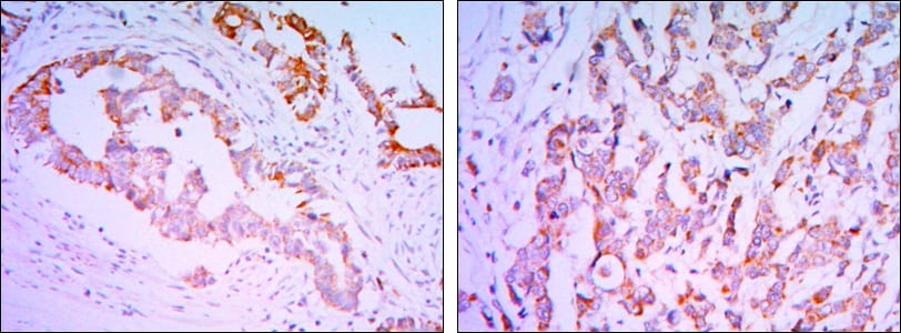 Figure 2: Immunohistochemical analysis of paraffin-embedded colon cancer tissues (left), breast carcinoma tissues (right) using SMAD2 Rabbit pAb with DAB staining.