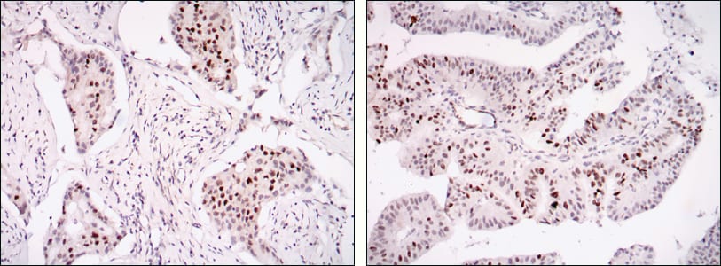 Figure 2: Immunohistochemical analysis of paraffin-embedded mammary cancer tissues (left), ovarian cancer tissues (right) using SP1 Rabbit pAb with DAB staining.