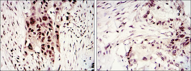 Figure 3: Immunohistochemical analysis of paraffin-embedded lung cancer tumor (left), esophagus cancer tissues (right) using CDK2 Rabbit pAb with DAB staining.