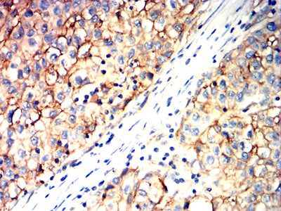 Figure 6:Immunohistochemical analysis of paraffin-embedded liver cancer tissues using TSPAN8 mouse mAb with DAB staining.