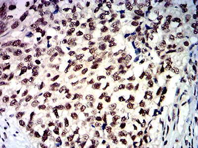 Figure 7:Immunohistochemical analysis of paraffin-embedded bladder cancer tissues using HDAC1 mouse mAb with DAB staining.