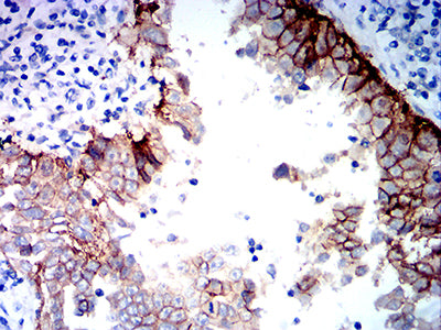 Figure 6:Immunohistochemical analysis of paraffin-embedded endometrial cancer tissues using CD151 mouse mAb with DAB staining.