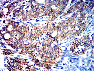 Figure 8:Immunohistochemical analysis of paraffin-embedded cervical cancer tissues using CDH1 mouse mAb with DAB staining.