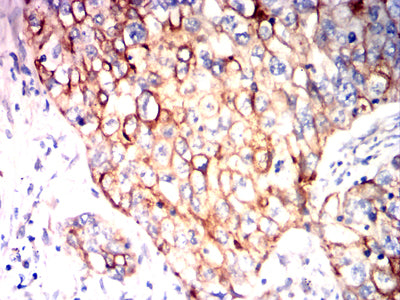 Figure 8:Immunohistochemical analysis of paraffin-embedded lung cancer tissues using NDC80 mouse mAb with DAB staining.