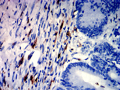 Figure 6:Immunohistochemical analysis of paraffin-embedded colon cancer tissues using CD226 mouse mAb with DAB staining.