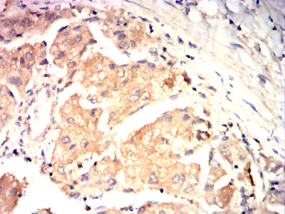 Figure 6:Immunohistochemical analysis of paraffin-embedded liver cancer tissues using CLEC2 mouse mAb with DAB staining.