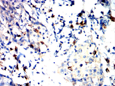 Figure 6:Immunohistochemical analysis of paraffin-embedded esophageal cancer tissues using TLR10 mouse mAb with DAB staining.