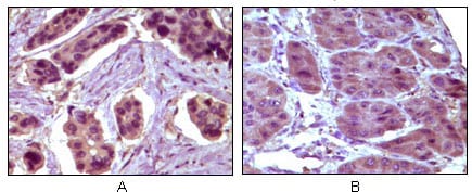 Figure 2: Immunohistochemical analysis of paraffin-embedded human breast carcinoma (A) and liver carcinoma (B), showing cytoplasmic localization using BCL10 mouse mAb with DAB staining.