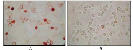 Figure 1: Immunocytochemistry analysis of TPA induced BCBL-1 cells (A) and uninduced BCBL-1 cells (B) using KSHV ORF62 mouse mAb with AEC staining.