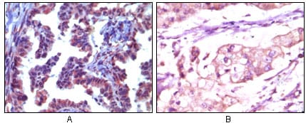 Figure 2: Immunohistochemical analysis of paraffin-embedded human metastatic adenocarcinoma(A) and stomach adenocarcinoma (B), showing cytoplasmic localization using Trim5? mouse mAb with AEC staining (A) and DAB staining(B).