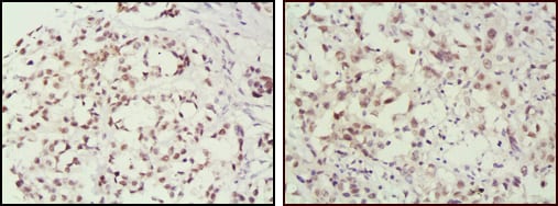 Figure 2: Immunohistochemical analysis of paraffin-embedded human breast cancer (left) and lung cancer (right) tissues, showing nuclear localization using MSH2 mouse mAb with DAB staining.