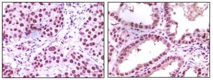 Figure 2: Immunohistochemical analysis of paraffin-embedded human lung carcinoma (left) and kidney carcinoma (right), showing nuclear localization using LSD1 mouse mAb with DAB staining.