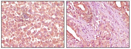 Figure 2: Immunohistochemical analysis of paraffin-embedded human skin carcinoma (left) and pancreas carcinoma (right) tissue, showing cytoplasmic localization using EphA2 mouse mAb with DAB staining.