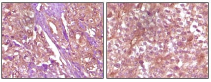 Figure 2: Immunohistochemical analysis of paraffin-embedded Human pancreas carcinoma (left) and breast carcinoma (right) tissue, showing membrane and cytoplasmic (pancreas carcinoma) localization, membrane (breast carcinoma) localization using EphB4 mouse mAb with DAB staining.