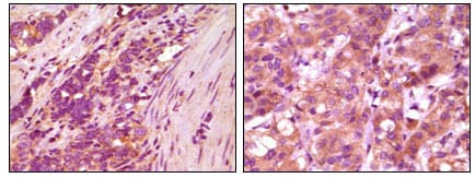 Figure 2: Immunohistochemical analysis of paraffin-embedded human stomach carcinoma (left) and breast carcinoma (right), showing cytoplasmic localization using fibulin5 mouse mAb with DAB staining.