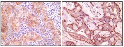 Figure 2: Immunohistochemical analysis of paraffin-embedded human ovary carcinoma (left) and breast carcinoma (right), showing cytoplasmic(ovary carcinoma) localization, cytoplasmic and nuclear (breast carcinoma) localization using SNCG mouse mAb with DAB staining.