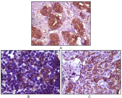 Figure 1: Immunohistochemical analysis of paraffin-embedded human breast tissue (A), lymph tissue (B) and skin carcinoma (C), showing membrane localization using BLK mouse mAb with DAB staining.