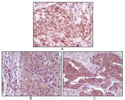 Figure 2: Immunohistochemical analysis of paraffin-embedded human pancreas carcinoma (A), esophagus carcinoma tissue (B) and ovary tumor tissue, showing cytoplasmic and membrane localization using 4E-BP1 mouse mAb with DAB staining.