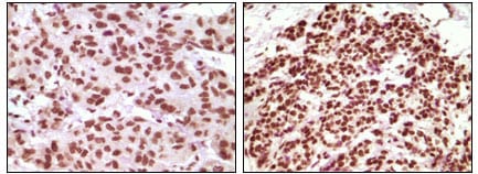 Figure 2: Immunohistochemical analysis of paraffin-embedded human infiltrating ductal carcinoma tissue(left) and simple carcinoma of breast cancer tissue(right), showing nuclear localization using PR mouse mAb with DAB staining.