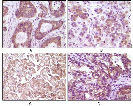 Figure 2: Immunohistochemical analysis of paraffin-embedded human colon carcinoma(A), breast carcinoma(B), kidney cell carcinoma(C), bladder carcinoma tumor(D), showing membrane and cytoplasmic localization using IKBKB mouse mAb with DAB staining.