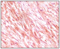 Figure 2: Immunohistochemical analysis of paraffin-embedded maligant mesenchymoma tissues, showing cytoplasmic localization using C-kit mouse mAb with DAB staining.