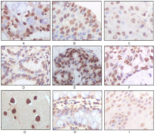 Figure 2: Immunohistochemical analysis of paraffin-embedded human lung adenocarcinoma (A), esophageal squamous cell carcinoma (B), hepatic cell carcinoma (C), thyroid tumor (D), breast adenofibroma (E), breast infiltrating ductal carcinoma (F), normal cerebrum tissue (G), normal colon tissue (H), normal esophageal tissue (I), showing nuclear localization using P16 mouse mAb with DAB staining.