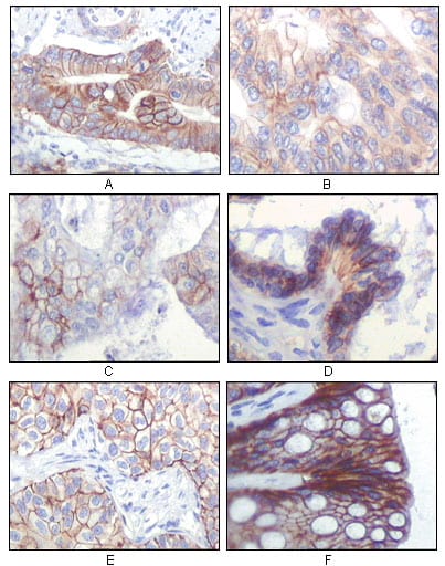 Figure 2: Immunohistochemical analysis of paraffin-embedded human gastric adenocarcinoma(A), colon adenocarcinoma(B), endometrial carcinoma(uterus)(C), ovary adenocarcinoma(D), lung squamous cell carcinoma(E), stomach epithelium mucosae(F), showing membrane localization using IGF1R-Beta mouse mAb with DAB staining.