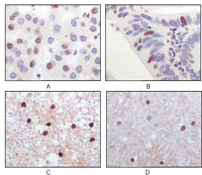 Figure 2: Immunohistochemical analysis of paraffin-embedded human liver carcinoma (A), recturn carcinoma (B), normal medulla tissue (C) and normal interbrain tissues (D), showing nuclear localization using Tip60 mouse mAb with DAB staining.