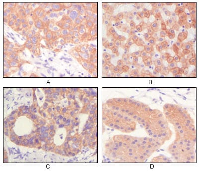 Figure 2: Immunohistochemical analysis of paraffin-embedded human lung squamous cell carcinoma (A),normal hepatocyte (B), colon adenocacinoma?, normal stomach tissue (D), showing cytoplasmic and membrane localization using CK mouse mAb with DAB staining.