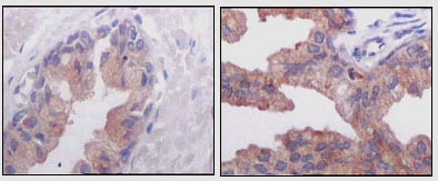 Figure 2: Immunohistochemical analysis of paraffin-embedded human normal prostate tissues (left) and prostate adenocarcinoma tissues (right), showing cytoplasmic localization using AMACR mouse mAb with DAB staining.