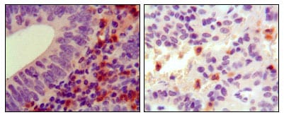 Figure 2: Immunohistochemical analysis of paraffin-embedded human colon cancer (left) and ancreas cancer (right), showing cytoplasmic localization using HCK mouse mAb with DAB staining.