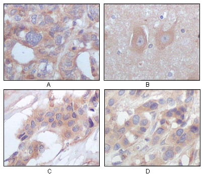 Figure 2: Immunohistochemical analysis of paraffin-embedded human ovary carcinoma (A), normal cerebrum tissues (B), breast infiltrating carcinoma (C) and breast infiltrating carcinoma (D), showing cytoplasmic localization using STYK1/NOK mouse mAb with DAB staining.
